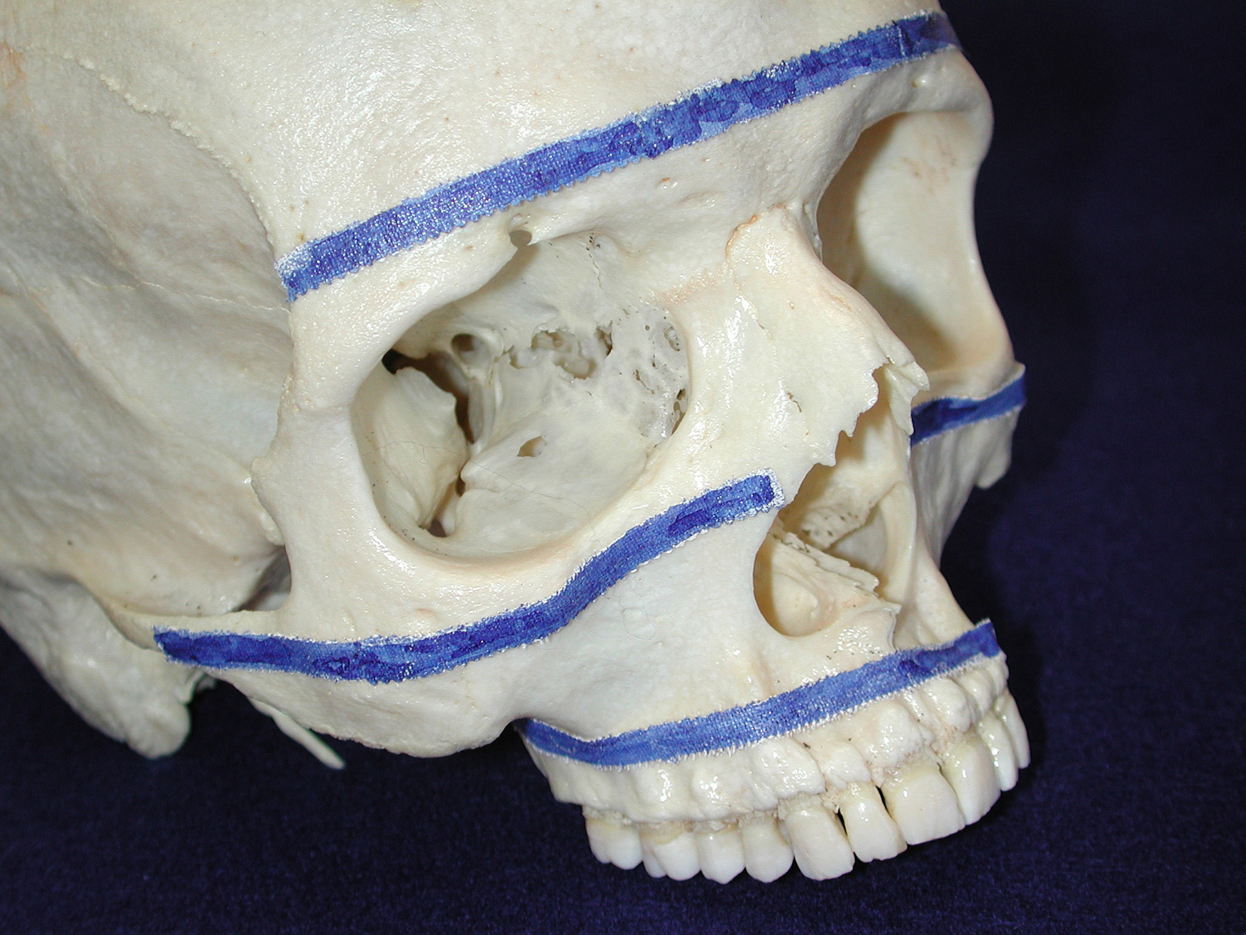 Dr Ashwin Kassan, Maxillofacial Trauma, Maxillo-facial and Oral Surgeon